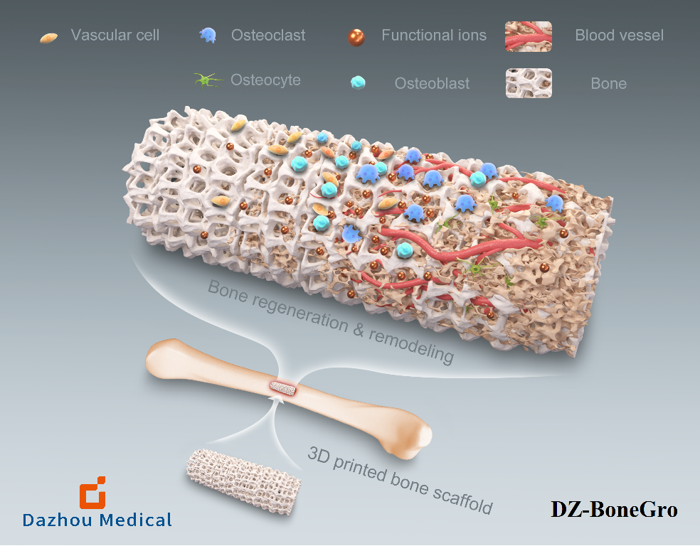 Products & Solutions_Orthopedic Implants _ DZ-BoneGro.png